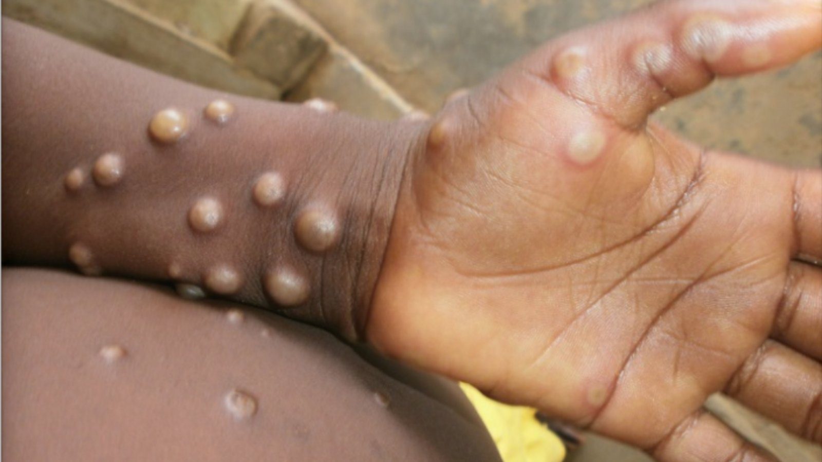 monkeypox Ευλογιά των πιθήκων